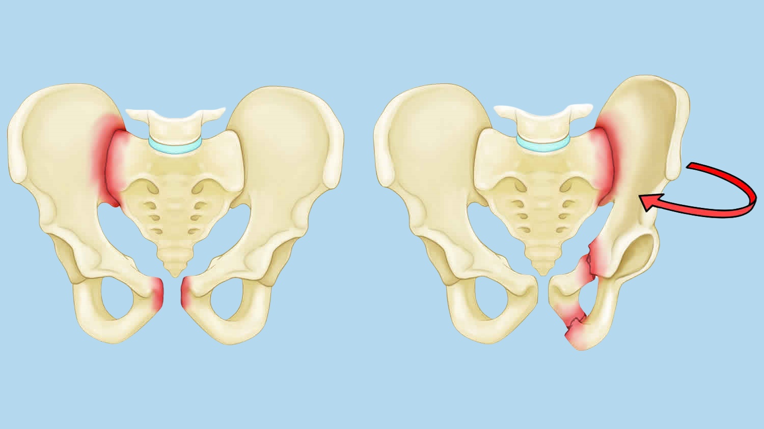 骨盆不稳定 pelvic instability