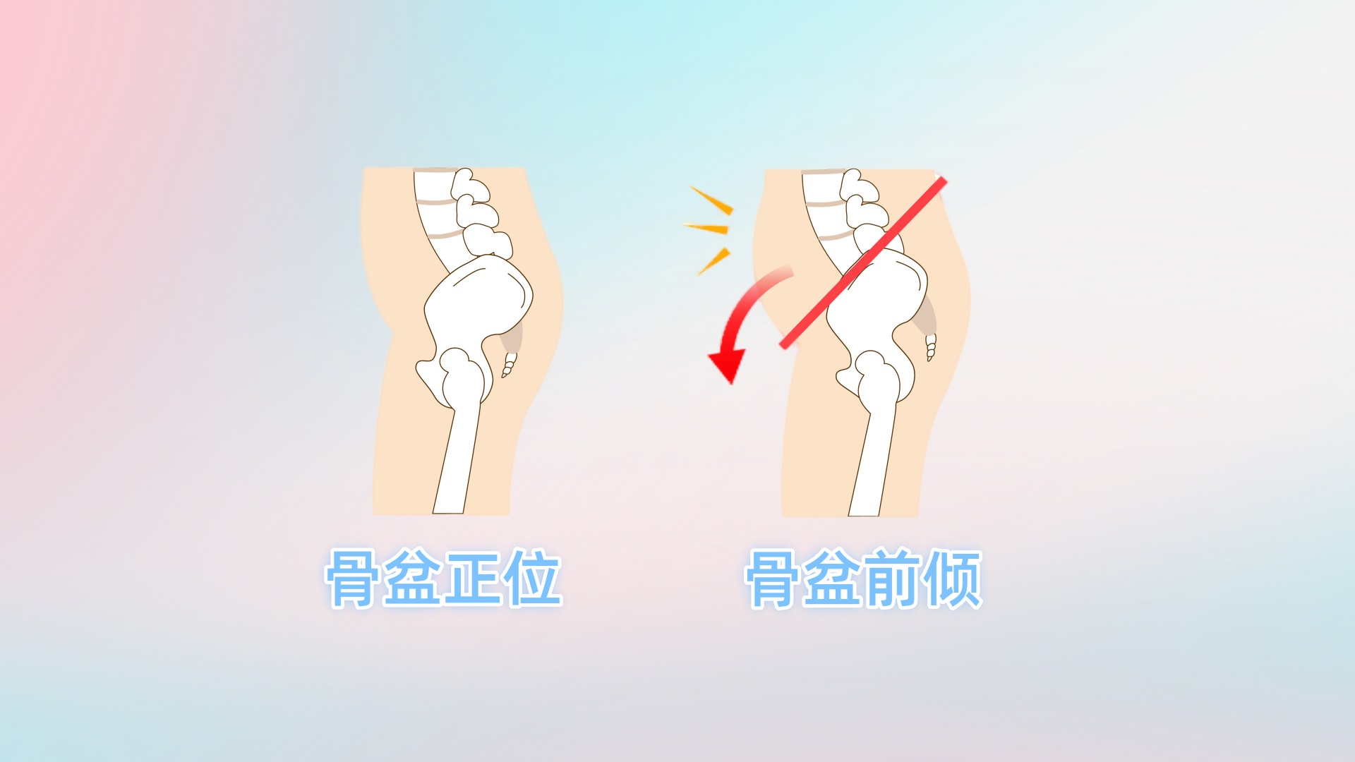 骨盆前倾 Anterior Pelvic Tilt