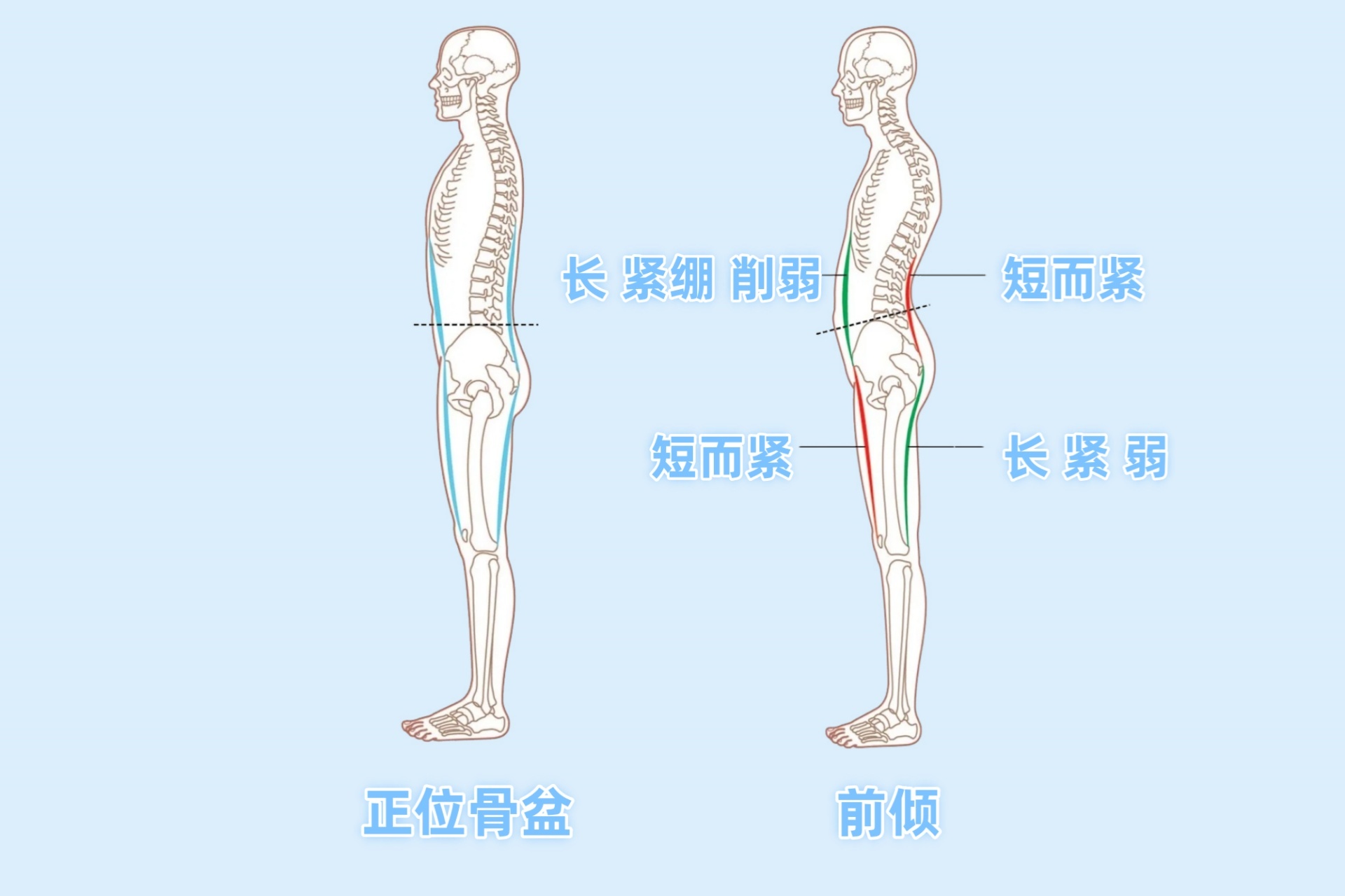 骨盆前倾 Anterior Pelvic Tilt3